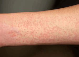 りんご病がうつった大人の腕の発疹
