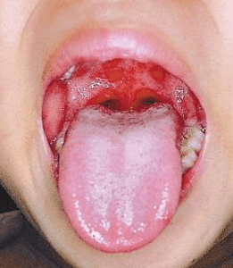 手足口病に感染してた口の中の水疱の症状